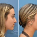 Rhinoplasty before and after photos in Voorhees, NJ, Patient 3699