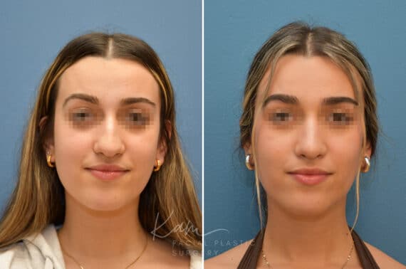 Rhinoplasty before and after photos in Voorhees, NJ, Patient 3699