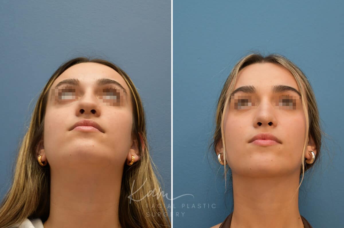 Rhinoplasty before and after photos in Voorhees, NJ, Patient 3699