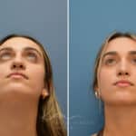 Rhinoplasty before and after photos in Voorhees, NJ, Patient 3699