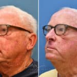 Mohs Reconstruction before and after photos in Voorhees, NJ, Patient 3708