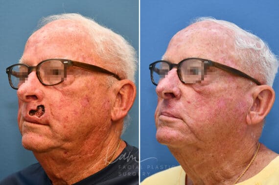 Mohs Reconstruction before and after photos in Voorhees, NJ, Patient 3708