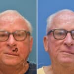Mohs Reconstruction before and after photos in Voorhees, NJ, Patient 3708