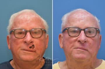 Mohs Reconstruction before and after photos in Voorhees, NJ, Patient 3708
