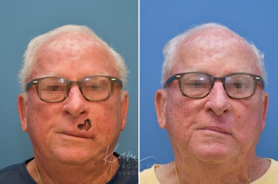 Mohs Reconstruction before and after photos in Voorhees, NJ, Patient 3708