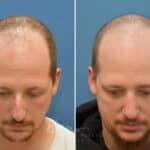 Rhinoplasty before and after photos in Voorhees, NJ, Patient 3953