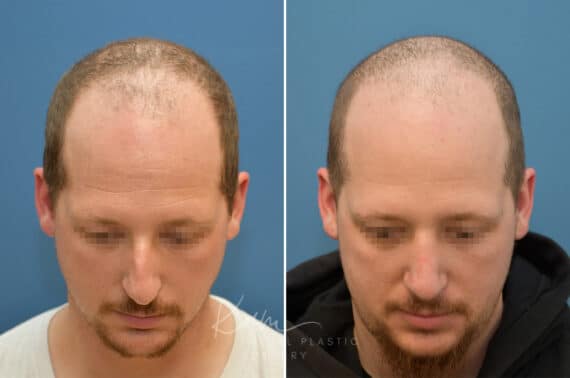 Rhinoplasty before and after photos in Voorhees, NJ, Patient 3953