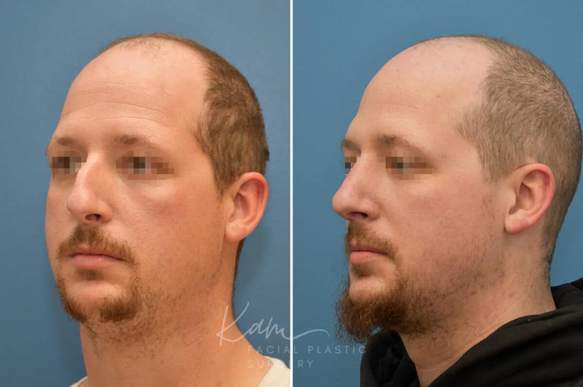 Rhinoplasty before and after photos in Voorhees, NJ, Patient 3953