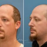 Rhinoplasty before and after photos in Voorhees, NJ, Patient 3953
