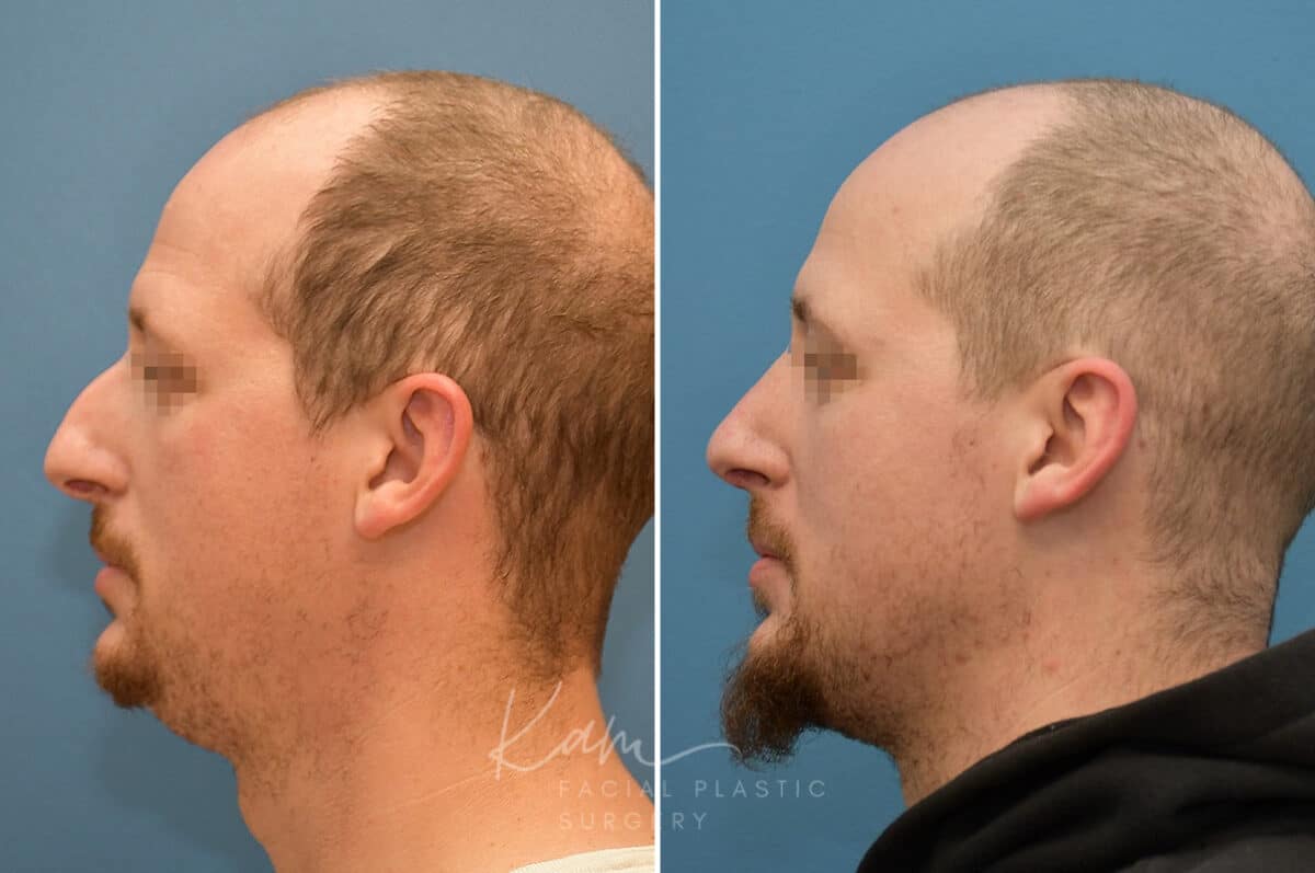 Rhinoplasty before and after photos in Voorhees, NJ, Patient 3953