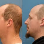 Rhinoplasty before and after photos in Voorhees, NJ, Patient 3953