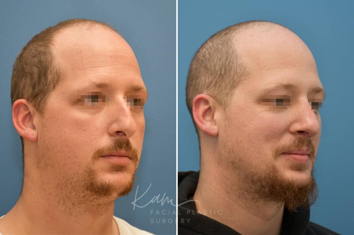 Rhinoplasty before and after photos in Voorhees, NJ, Patient 3953