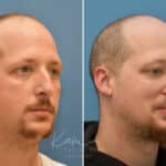 Rhinoplasty before and after photos in Voorhees, NJ, Patient 3953