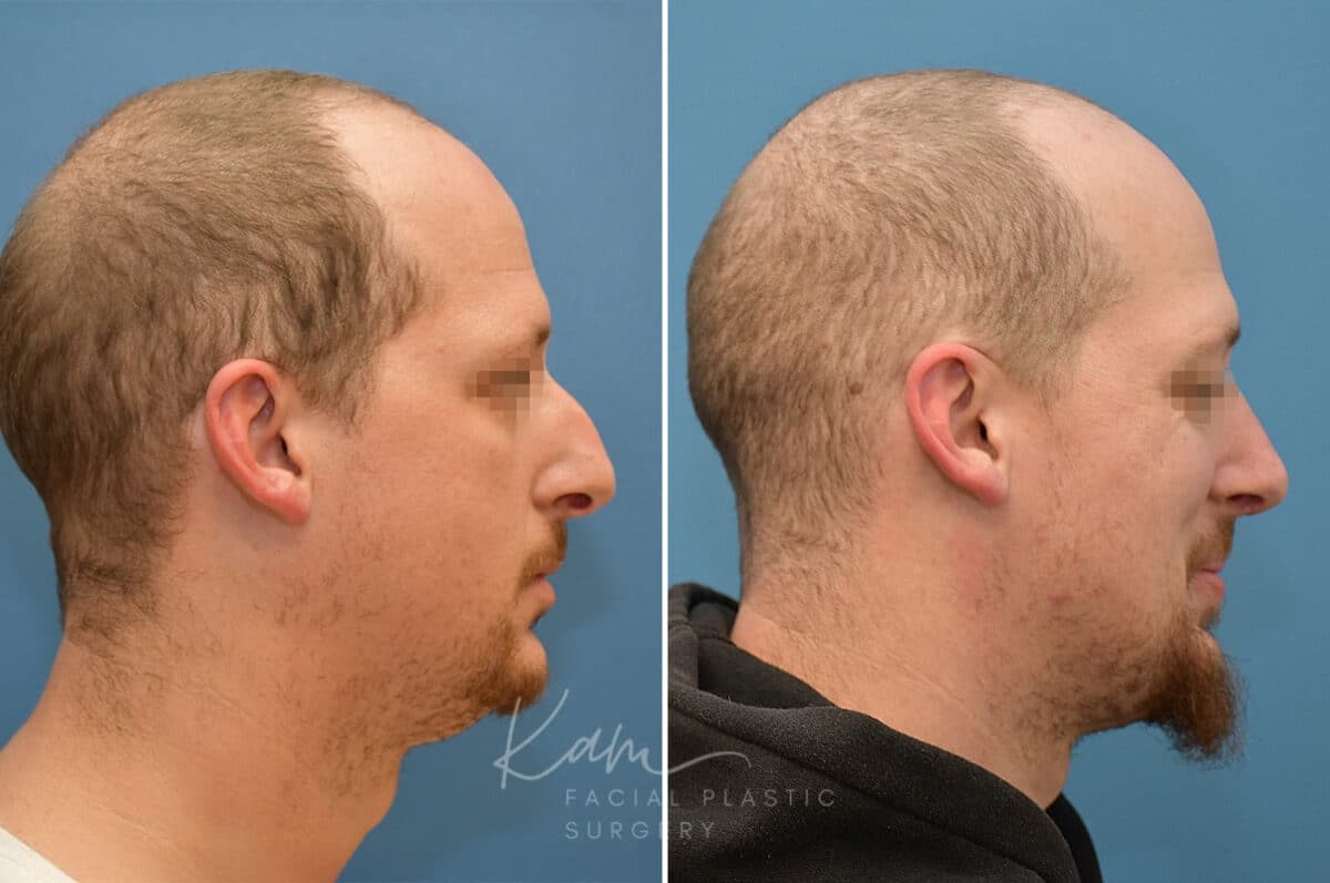 Rhinoplasty before and after photos in Voorhees, NJ, Patient 3953
