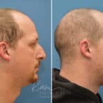 Rhinoplasty before and after photos in Voorhees, NJ, Patient 3953