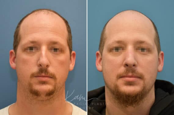 Rhinoplasty before and after photos in Voorhees, NJ, Patient 3953