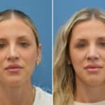 Rhinoplasty before and after photos in Voorhees, NJ, Patient 3972
