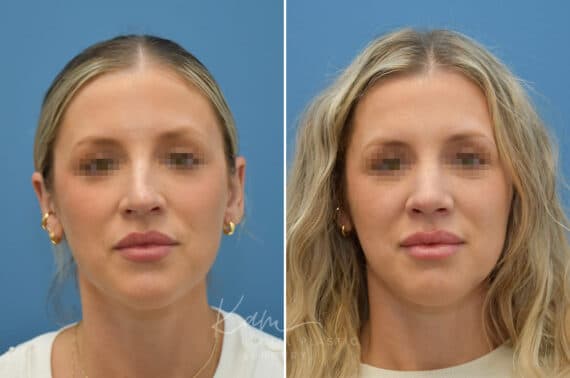 Rhinoplasty before and after photos in Voorhees, NJ, Patient 3972
