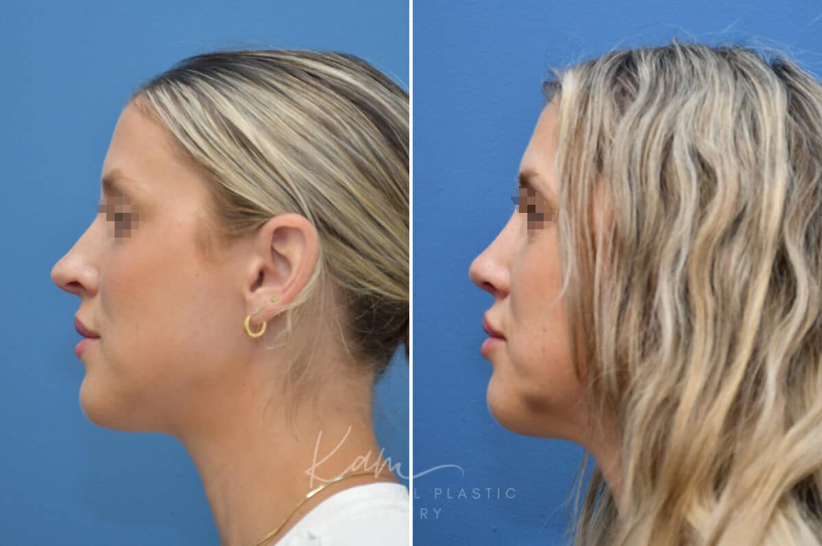 Rhinoplasty before and after photos in Voorhees, NJ, Patient 3972
