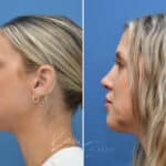 Rhinoplasty before and after photos in Voorhees, NJ, Patient 3972