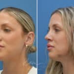 Rhinoplasty before and after photos in Voorhees, NJ, Patient 3972