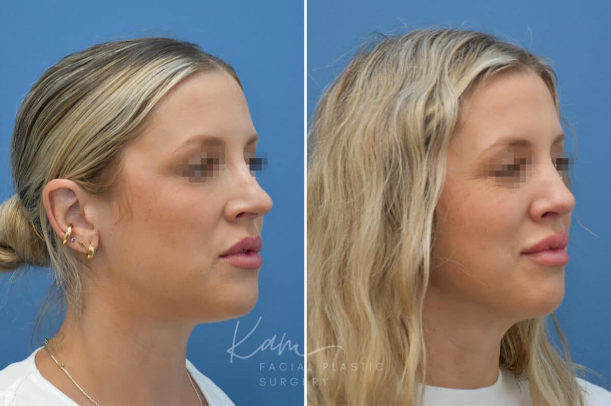 Rhinoplasty before and after photos in Voorhees, NJ, Patient 3972