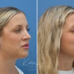 Rhinoplasty before and after photos in Voorhees, NJ, Patient 3972
