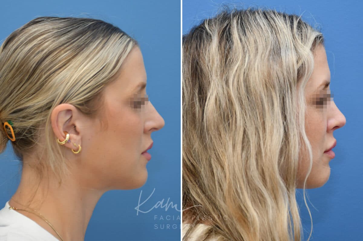 Rhinoplasty before and after photos in Voorhees, NJ, Patient 3972