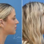 Rhinoplasty before and after photos in Voorhees, NJ, Patient 3972