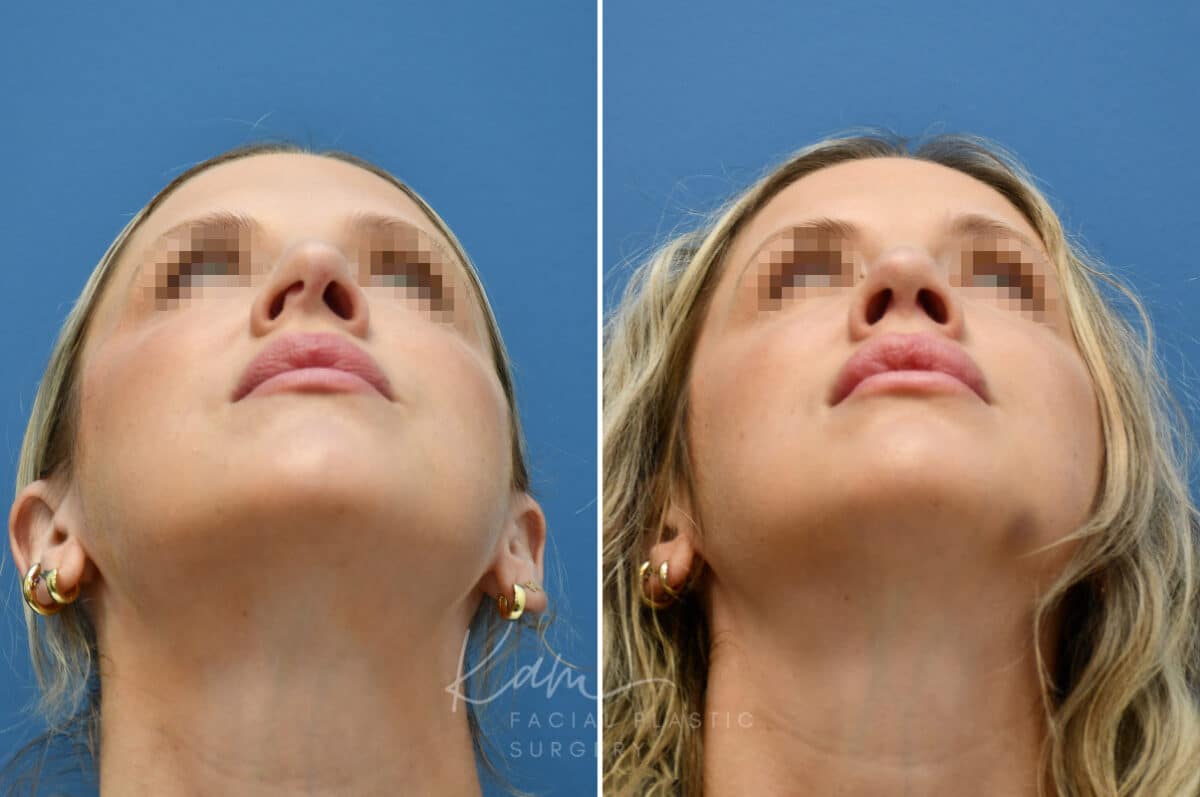 Rhinoplasty before and after photos in Voorhees, NJ, Patient 3972