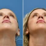 Rhinoplasty before and after photos in Voorhees, NJ, Patient 3972