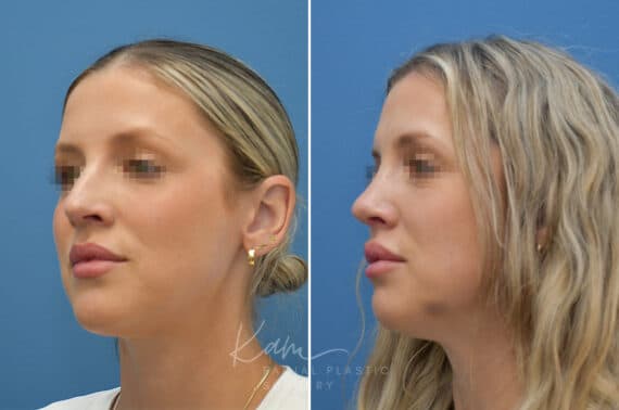 Rhinoplasty before and after photos in Voorhees, NJ, Patient 3972