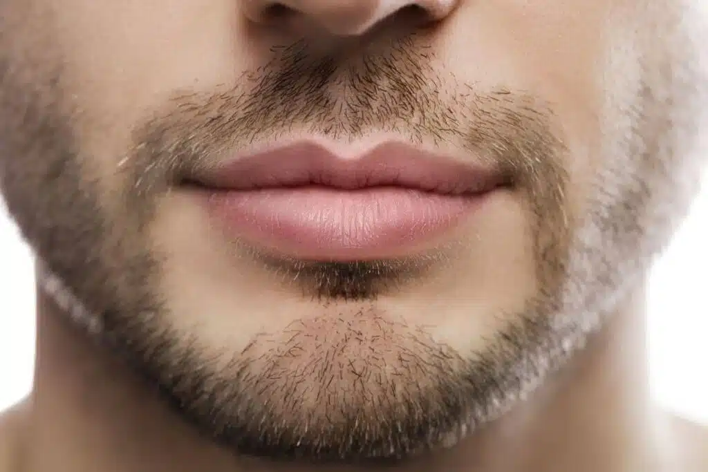 Detailed view of male lips with facial hair highlighting subtle enhancement and masculine-focused lip lift results.