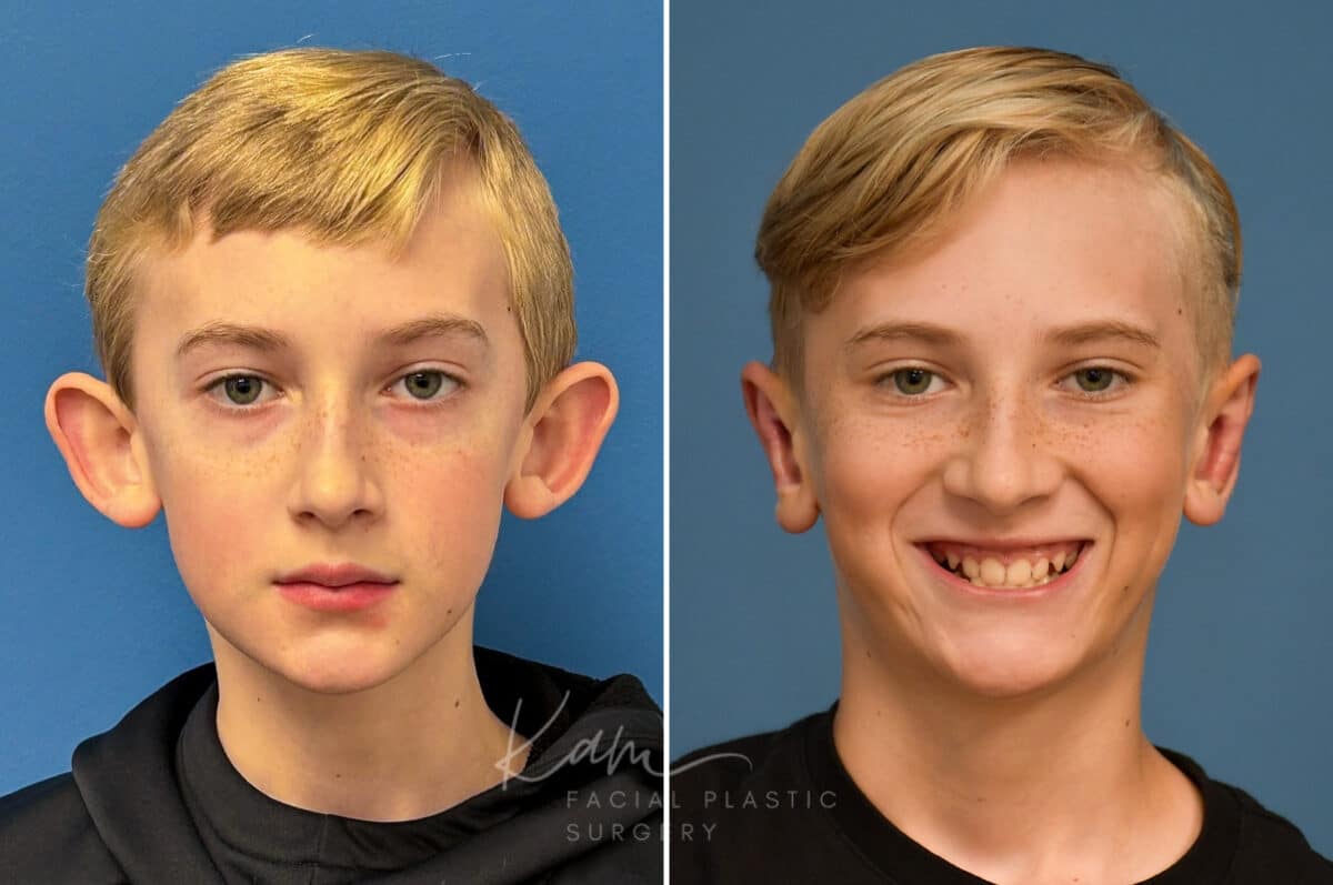 Otoplasty before and after photos in Voorhees, NJ, Patient 4995