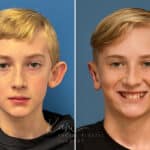 Otoplasty before and after photos in Voorhees, NJ, Patient 4995