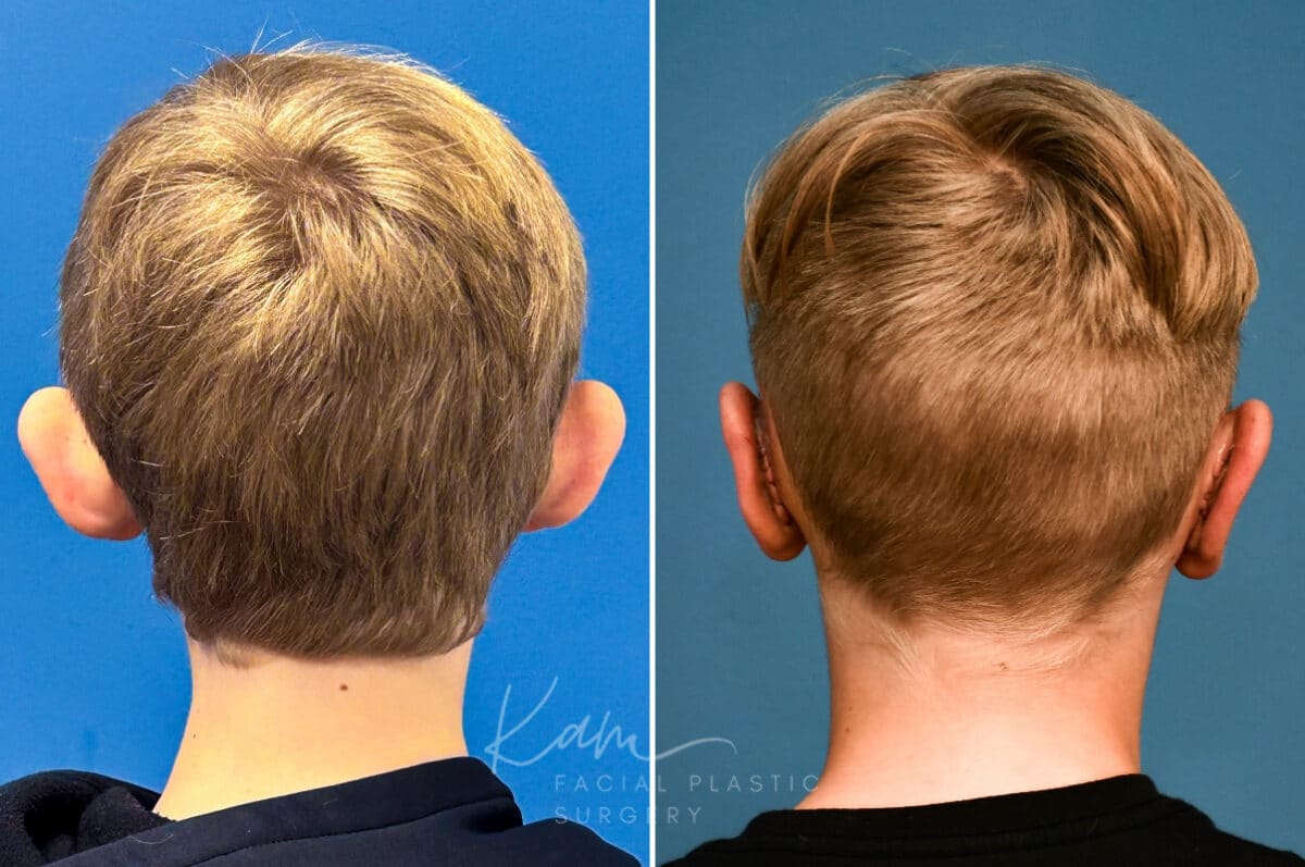 Otoplasty before and after photos in Voorhees, NJ, Patient 4995