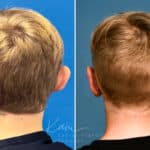 Otoplasty before and after photos in Voorhees, NJ, Patient 4995
