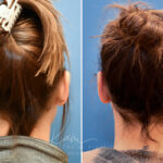 Otoplasty before and after photos in Voorhees, NJ, Patient 2307