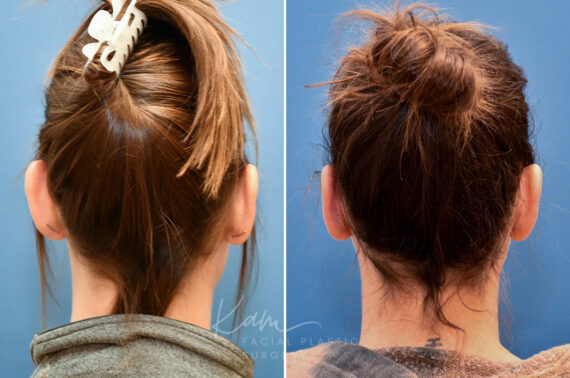 Otoplasty before and after photos in Voorhees, NJ, Patient 2307