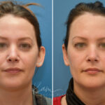Otoplasty before and after photos in Voorhees, NJ, Patient 2307