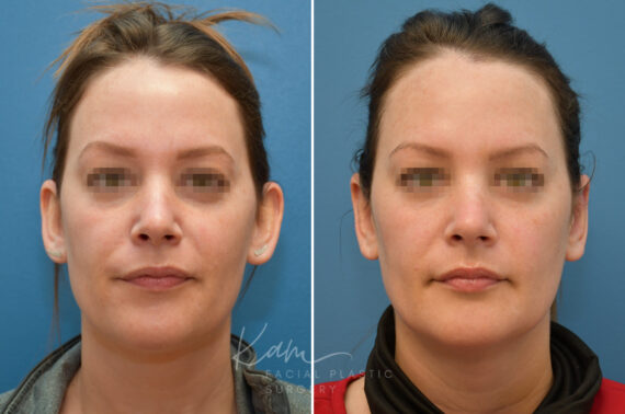 Otoplasty before and after photos in Voorhees, NJ, Patient 2307