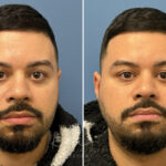 Buccal Fat Excision before and after photos in Voorhees, NJ, Patient 4991