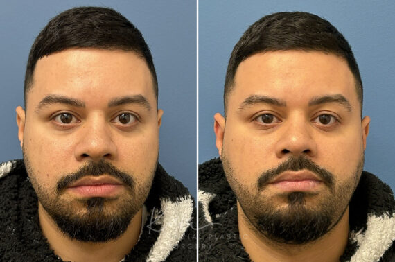 Buccal Fat Excision before and after photos in Voorhees, NJ, Patient 4991