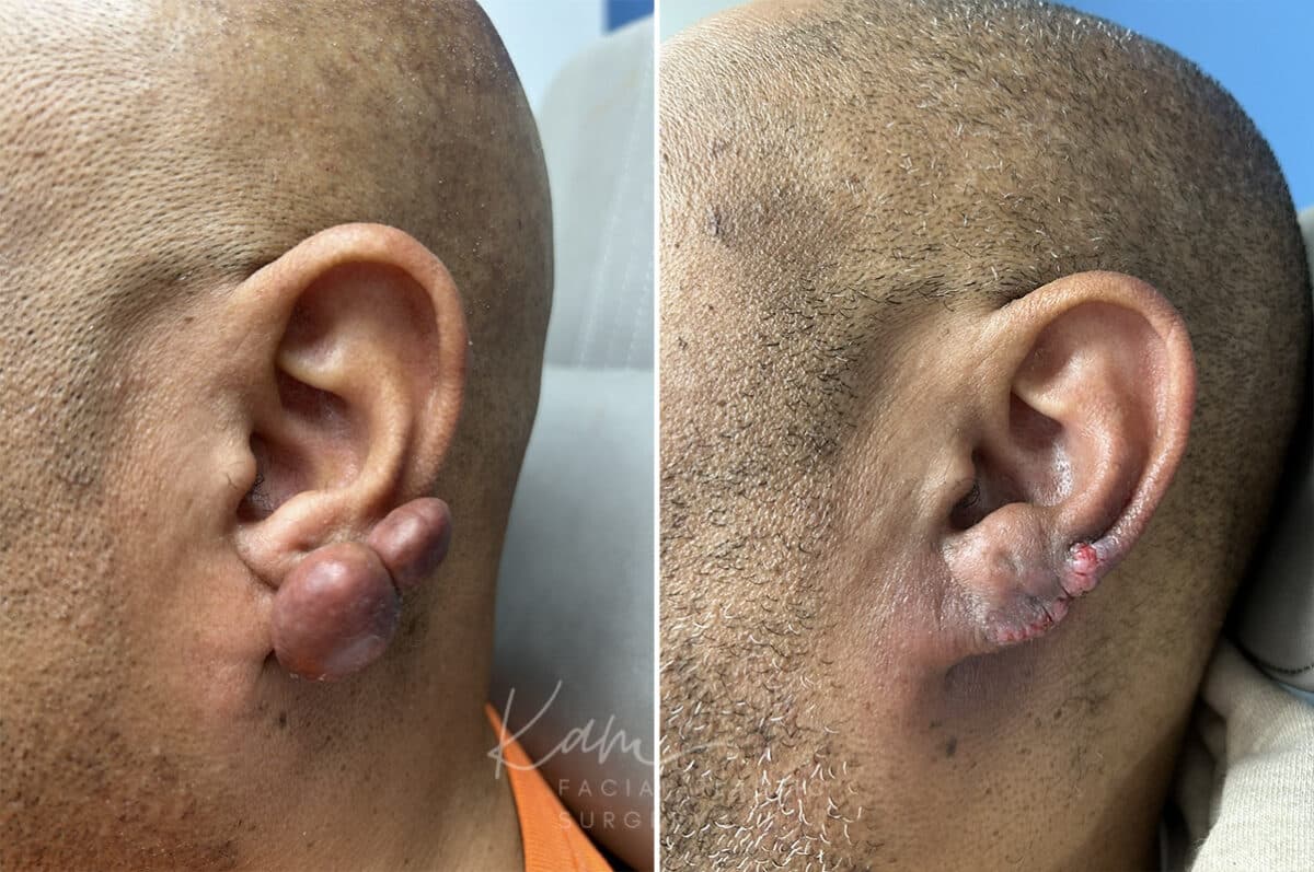Keloid Removal before and after photos in Voorhees, NJ, Patient 5020