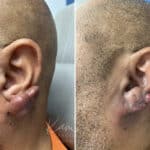 Keloid Removal before and after photos in Voorhees, NJ, Patient 5020
