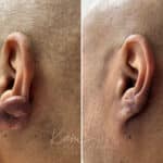 Keloid Removal before and after photos in Voorhees, NJ, Patient 5020