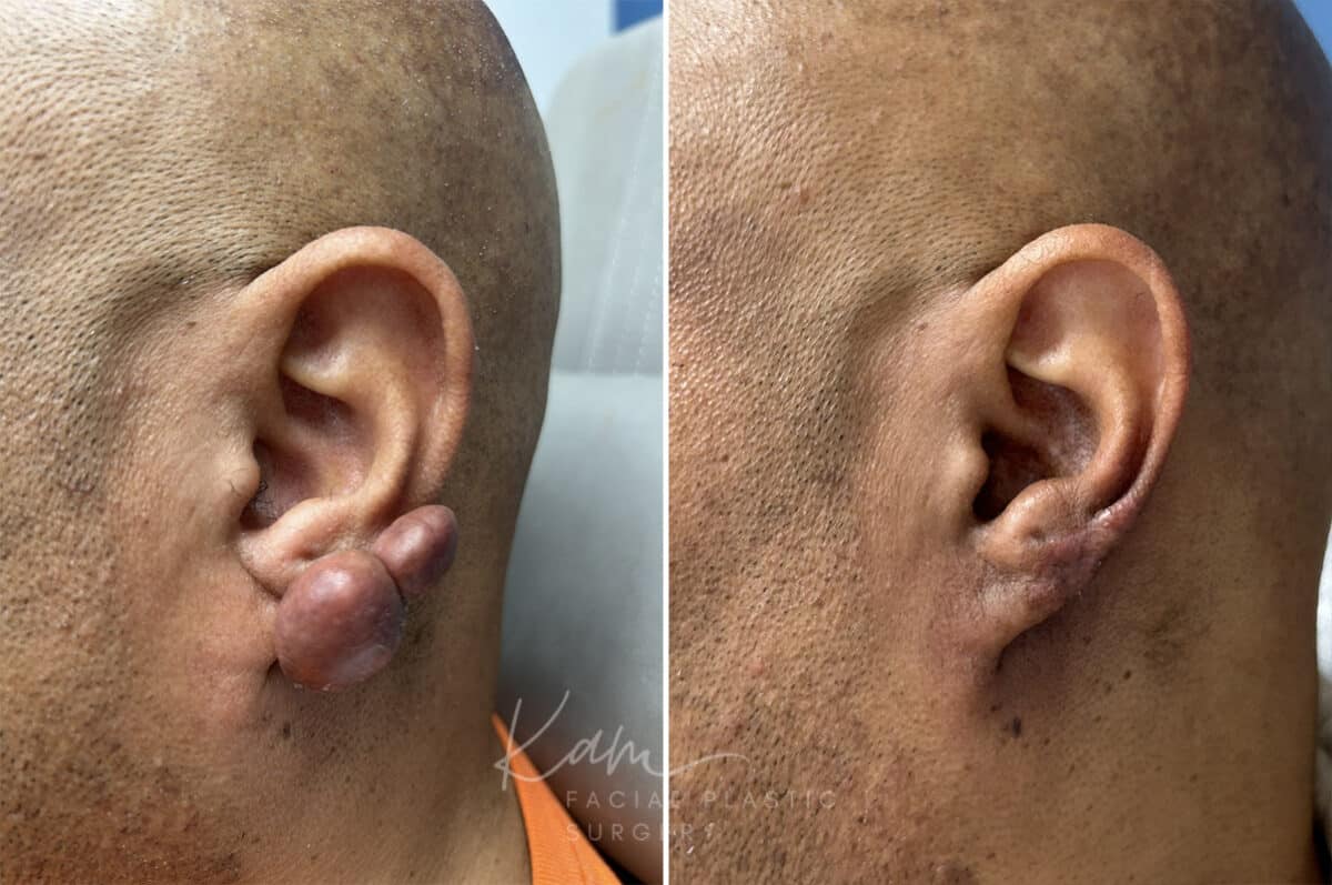 Keloid Removal before and after photos in Voorhees, NJ, Patient 5020