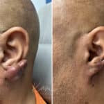 Keloid Removal before and after photos in Voorhees, NJ, Patient 5020