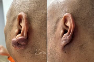Keloid Removal before and after photos in Voorhees, NJ, Patient 5020