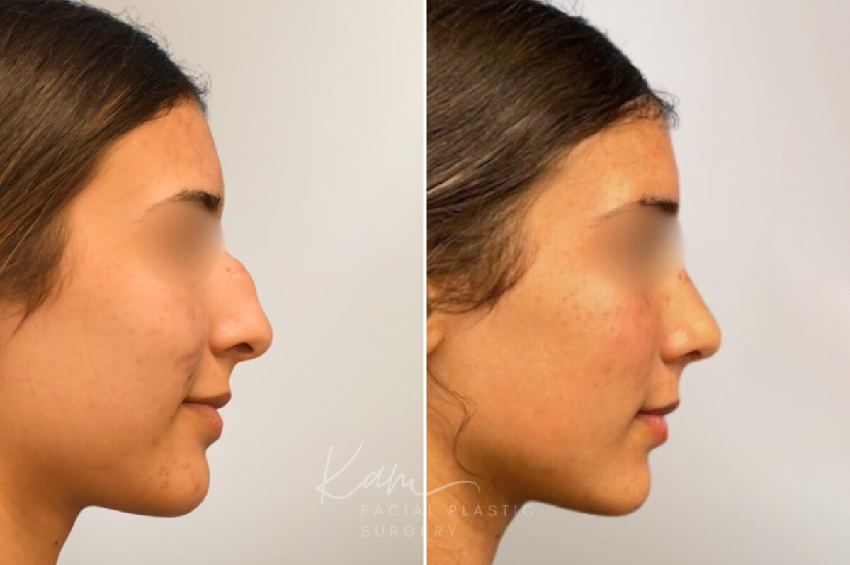Rhinoplasty before and after photos in Voorhees, NJ, Patient 5029